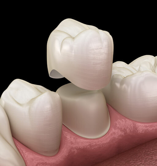 Dental crown procedure showing tooth restoration with a custom-made crown